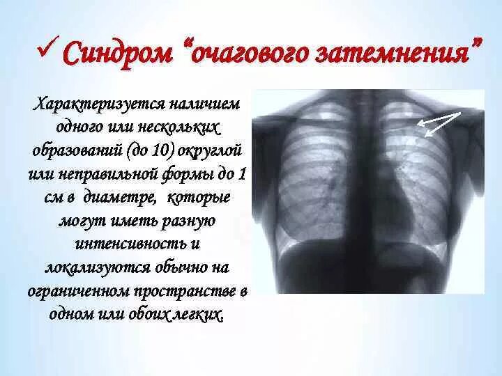 Диссеминированный туберкулез рентген. Очаговые заболевания легких. Очаговые тени в легких. Очаговый туберкулез рентгенологическая картина. Очаговые тени не определяются.
