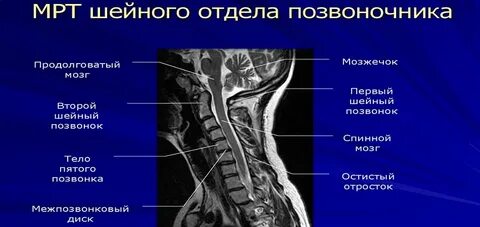 3 и 4 позвонки шейного отдела
