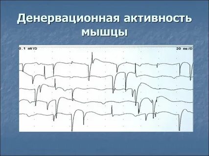 Недостаточная мышечная активность