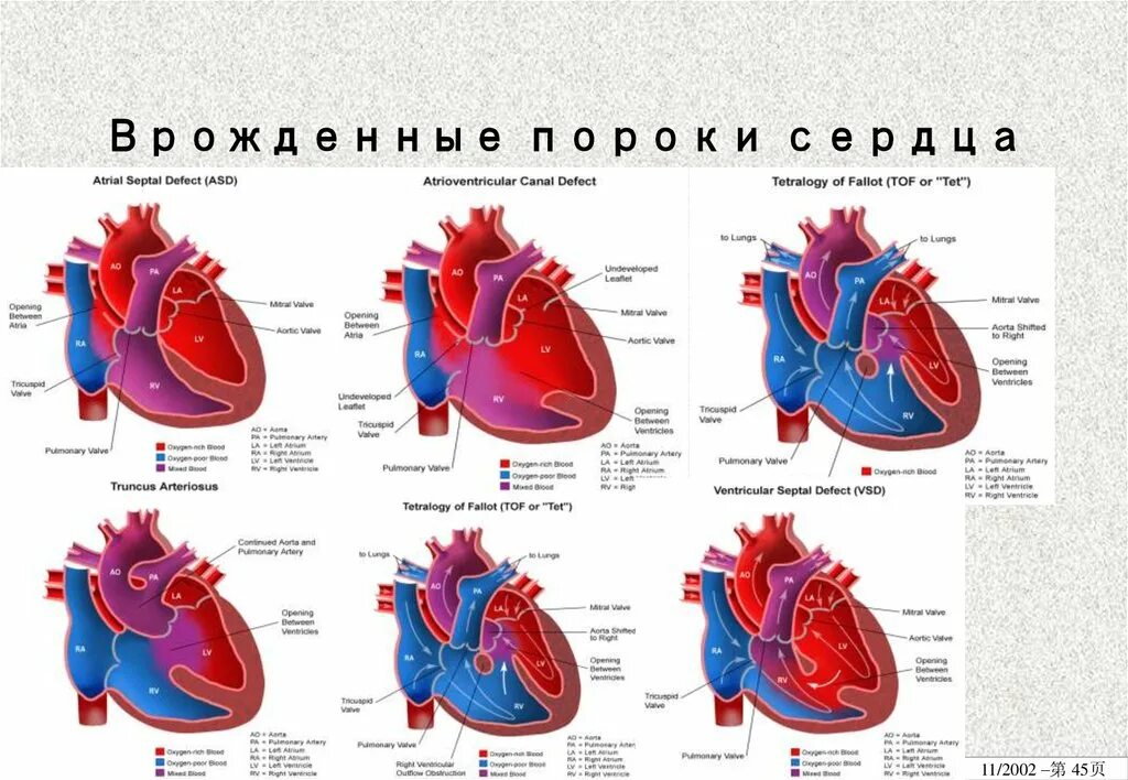 Схемы врожденных пороков сердца. Классификация пороков сердца патанатомия. Зарисуйте врожденные пороки сердца. Врождённые пороки сердца классификация рисунки.