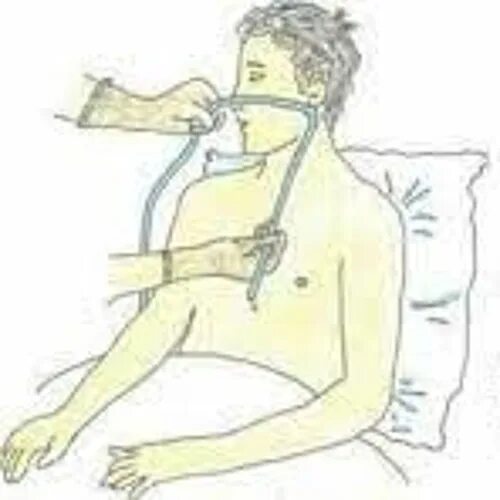 Тонкий желудочный зонд для промывания желудка. Желудочный зонд для промывания желудка. Промывание желудка толстым зондом алгоритм. Техника промывания желудка через зонд алгоритм. Назогастральная интубация.