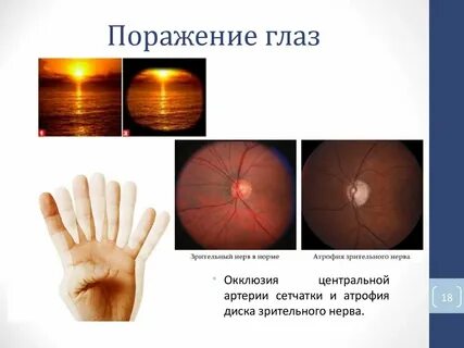 Поражение зрительного нерва