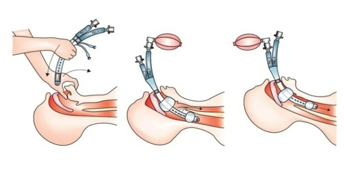 Трубка при наркозе. Интубация трахеи эндотрахеальной трубкой. Интубация трахеи методика выполнения.