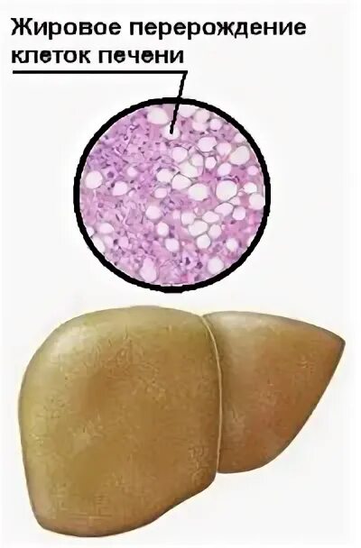 Перерождение клеток печени. Жировой гепатоз печени патанатомия. Жировая дистрофия печени(жировой гепатоз). Печень гепатоз жировой гепатоз. Жировой гепатоз печени этиология патанатомия.