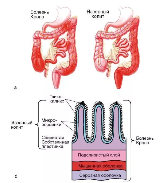 Илеоколит. Болезнь крона этиология. Схема поражения кишки при болезни крона. Неспецифический язвенный колит этиология. Неспецифический язвенный колит патогенез схема.