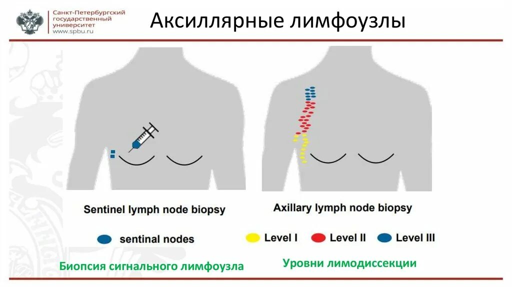 Биопсия сигнального лимфатического узла. Лимфатические узлы груди онкология. Лимфоузлы млоочно йжелезхы. Биопсия сигнальных лимфоузлов у больных РМЖ. Аксиллярная лимфаденопатия молочной