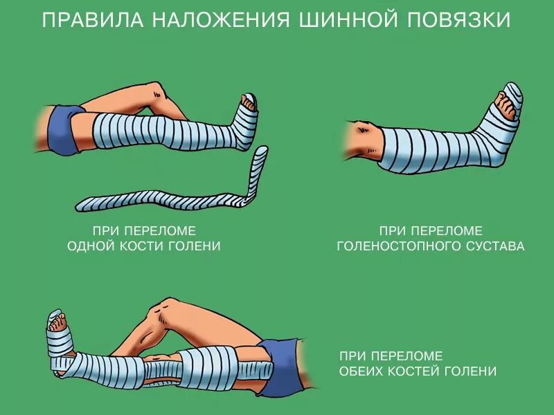 Алгоритм при переломе голени. Как правильно накладывать шину при переломе. при переломах костей конечностей накладывается шина:. шина крамера при переломе голени. накладывание шины при переломе.