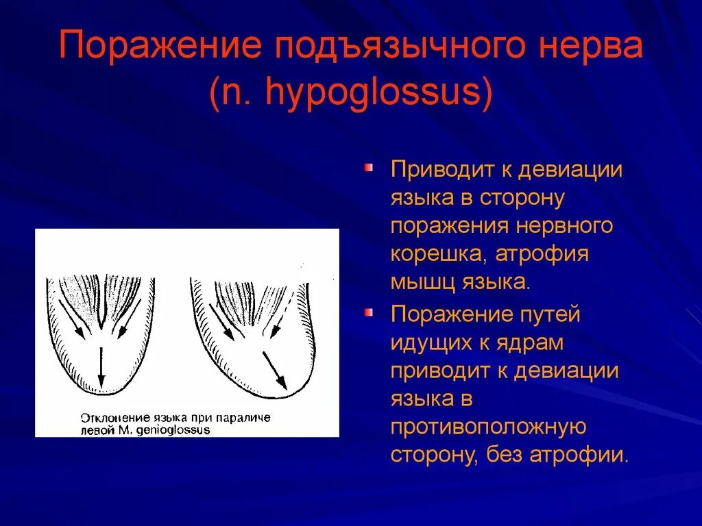 Паралич подъязычного нерва. Синдром поражения подъязычного нерва. Центральный парез подъязычного нерва. Поражение подъязычного нерва