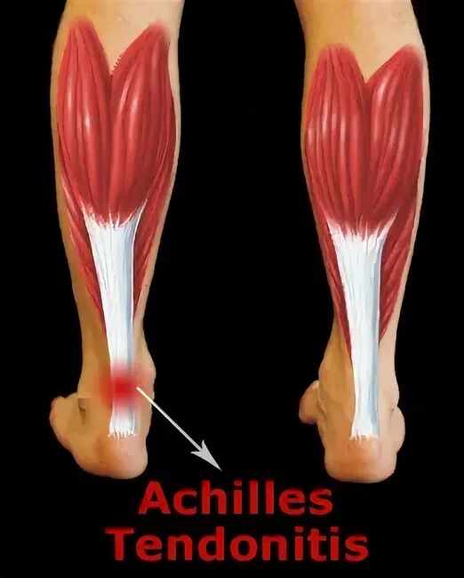 Подрезать сухожилие. Подрезать сухожилие. Разрыв ахиллова сухожилия. Тендинит коленного сустава симптомы. Подрезать сухожилие.
