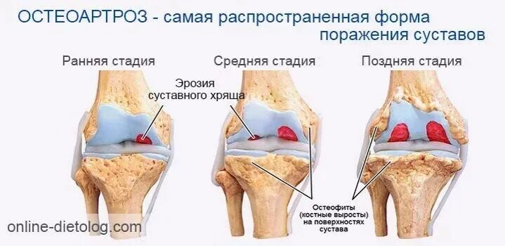 Восстановление суставов и хрящей. Хрящевая ткань коленного сустава. Регенерация хрящевой ткани суставов. Восстановление сустава без операции