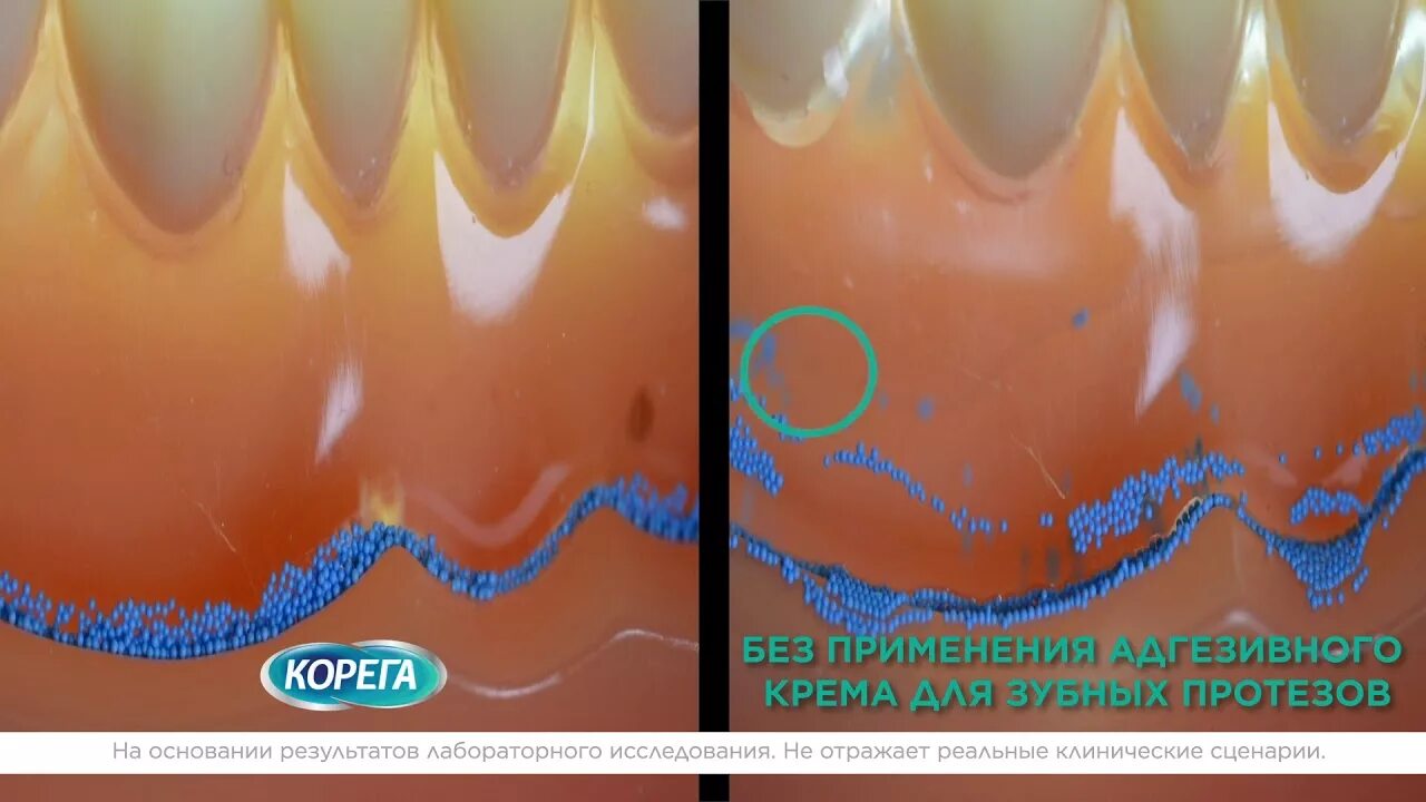 Как правильно наносить корегу на протез. Съемные зубные протезы на Кореге. Нанесение крема Корега на протез.