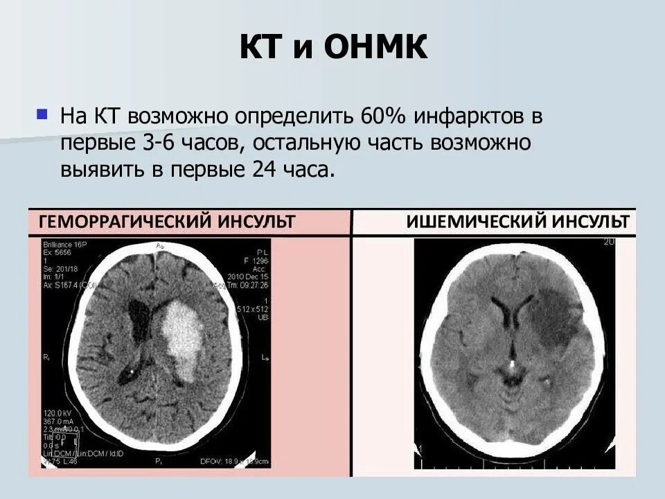 Можно по кт определить. Ишемический инсульт кт и мрт. ОНМК по ишемическому типу кт. Геморрагический инсульт кт. Ишемический инсульт кт картина.