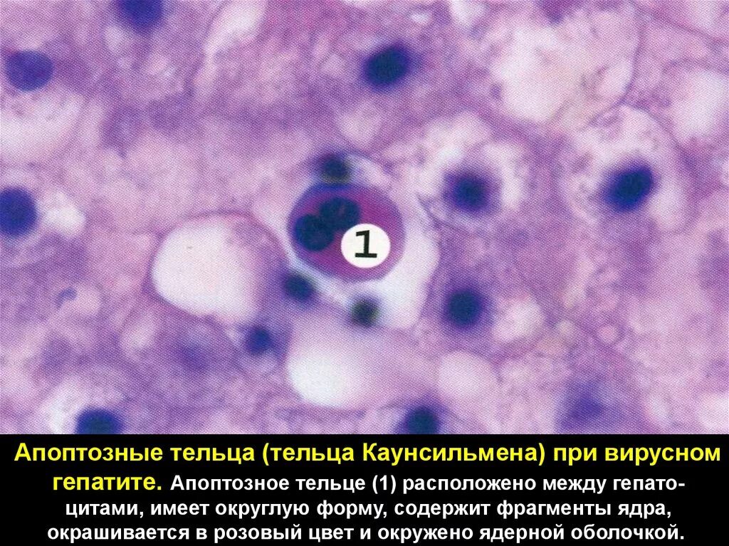 Синдром тельца. Тельце каунсильмена гистология. Тельца Маллори и каунсильмена. Тельца каунсильмена микропрепарат. Апоптозные тельца каунсильмена микропрепарат.