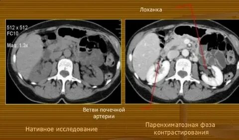 Кт почки с контрастом сколько по времени