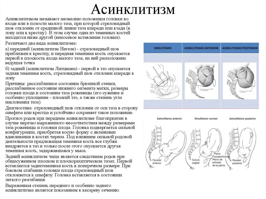 Положения головки плода. Асинклитическое положение плода. Асинклитизм Редерера. Передний асинклитизм биомеханизм родов. Литцмановский асинклитизм.