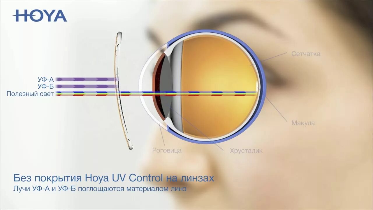 Хрусталик hoya. Линза acrysof iq. Линзы интраокулярные acrysof iq sn60wf. Иол alcon acrysof. Линза acrysof iq.