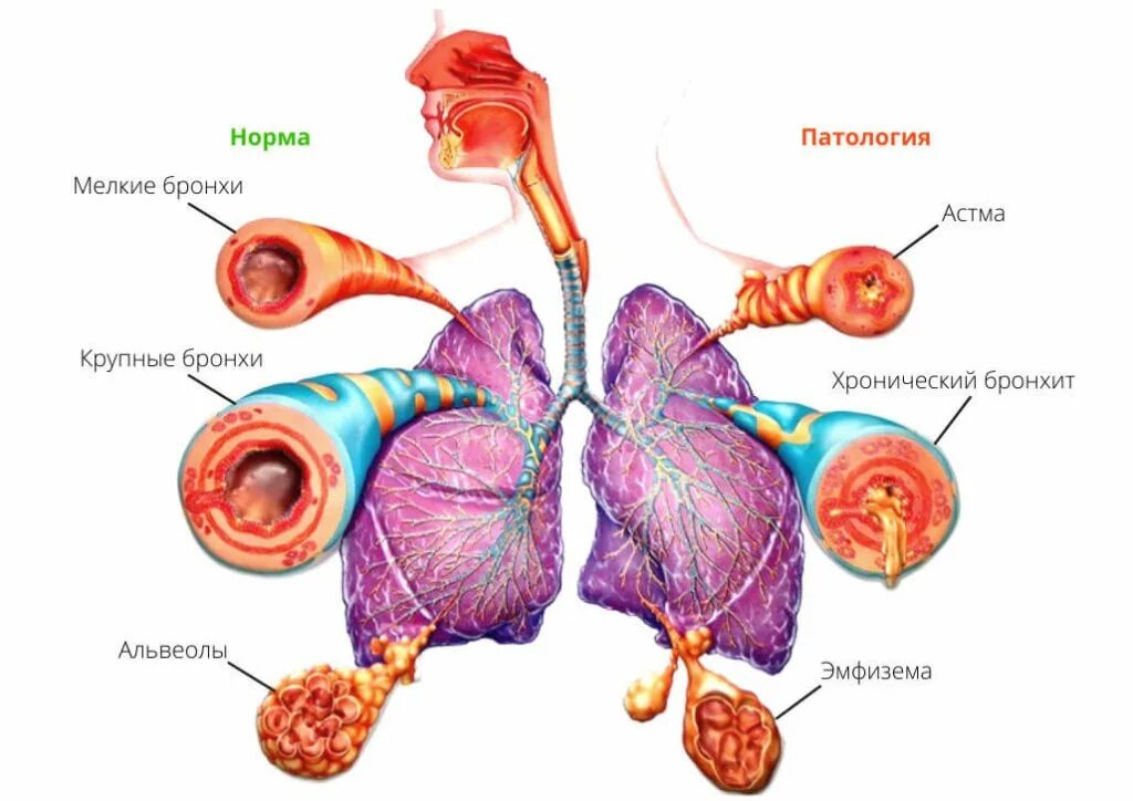 Хроническими болезнями легких астмой. Патогенез пылевого бронхита. Патогенез бронхиальной астмы. Хронический бронхит схема. Альвеолы при астме.