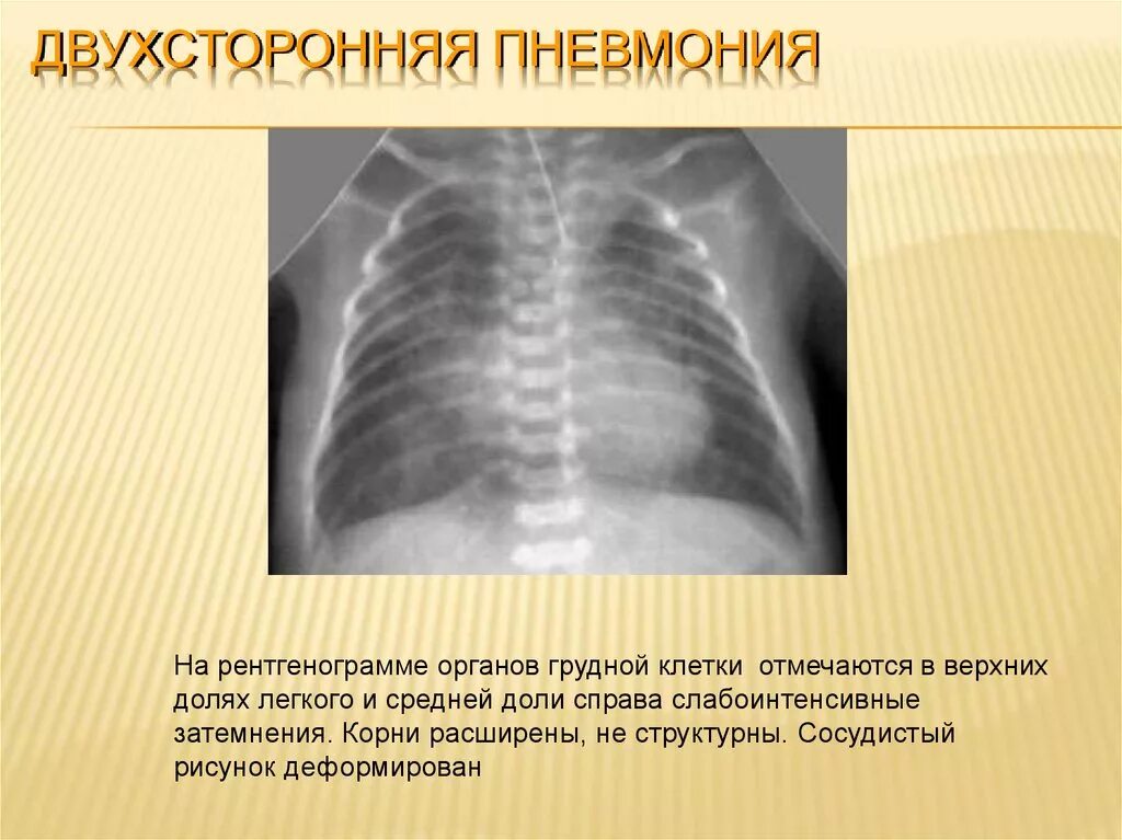 После двухсторонней пневмонии