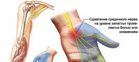 Как снять онемение левой руки Кисть руки ночью немеют и болят 25/48