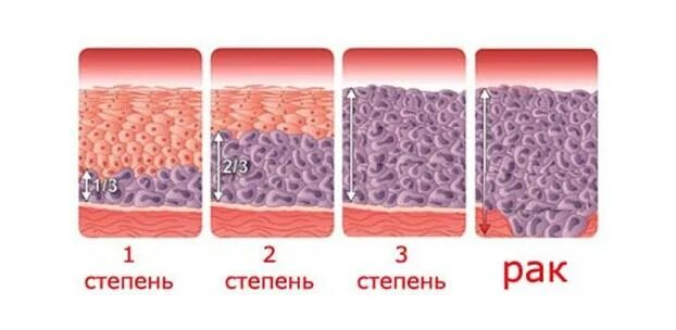 Изменения эпителия матки. Дисплазия эпителия гистология. Дисплазия шейки матки Cin 1-2. Дисплазия эпителия 3 степени. Дисплазия шейки матки 2 степени гистология.