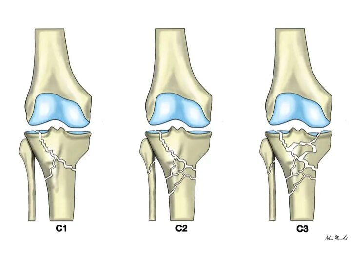 Мыщелки колена. Перелом медиального мыщелка большеберцовой кости рентген. Перелом наружного мыщелка большеберцовой кости. Внутренний перелом мыщелка берцовой кости. Перелом задних отделов латерального мыщелка большеберцовой кости.