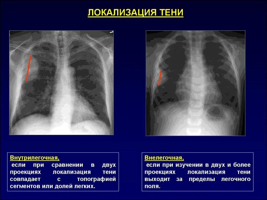 Верхние доли легких тени. Локализация пневмонии. Синдром кольцевидной тени. Синдром кольцевидной тени в легком. Кольцевидная тень в легком рентгенологический признак чего.