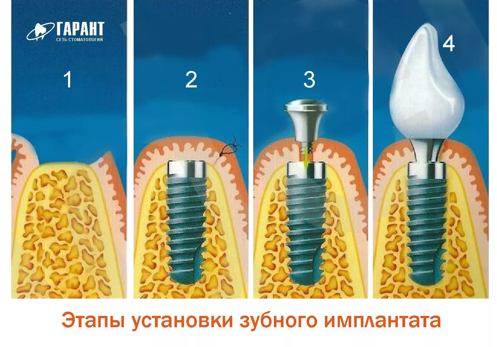 Имплантация зуба этапы и сроки