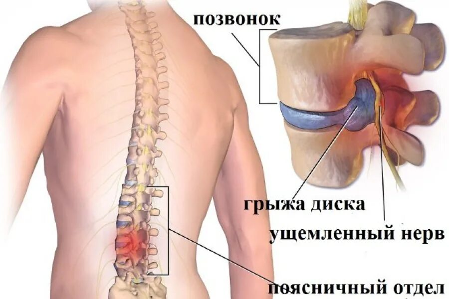 Грыжи l
