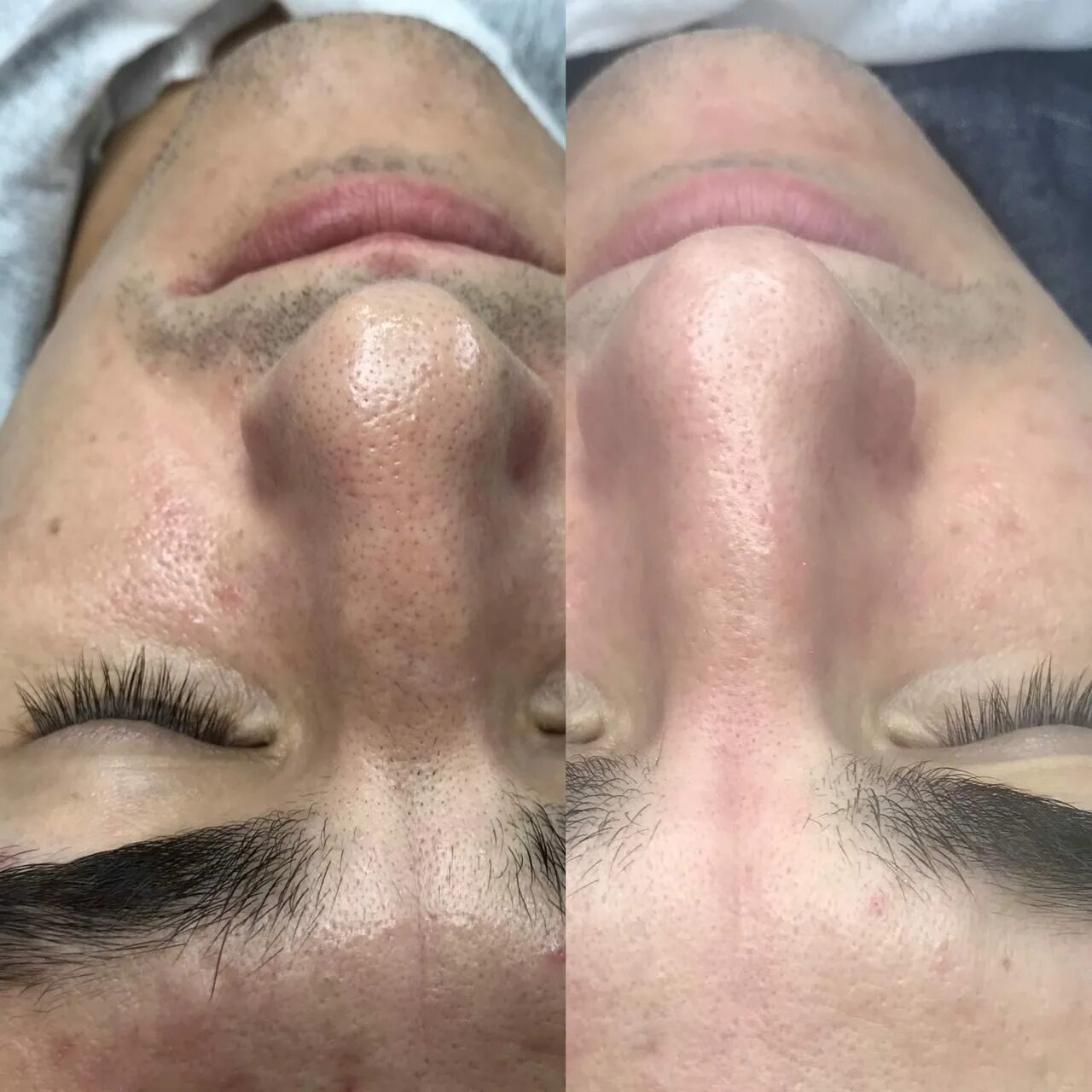 мужской косметолог. атравматическая чисткаица. косметология для мужчин. ультразвуковая чистка лица. комбинированная чистка.