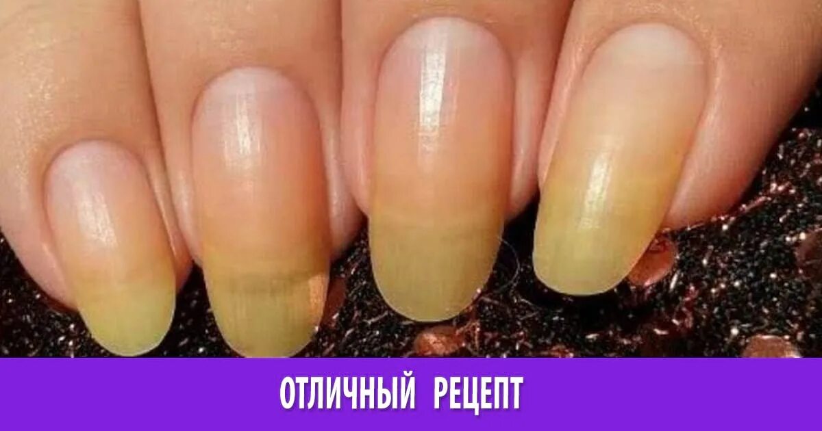 Отбеливание ногтей. Отбелить ногти. Как отрастить ногти. Средства для отбеливания кончиков ногтей. Отбеливание кончиков ногтей.