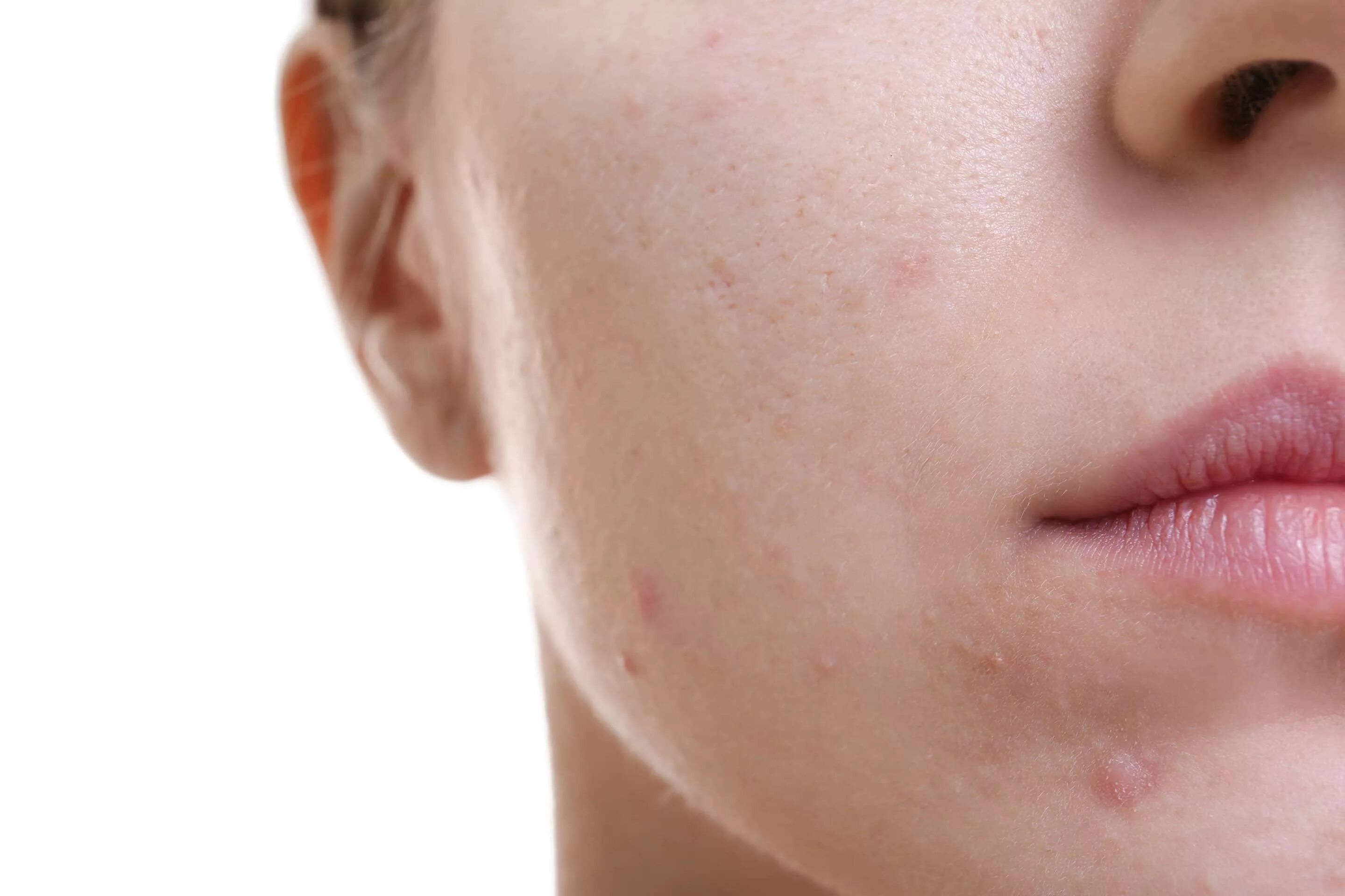 Пятна на лице женщины. Угревая сыпь (acne vulgaris); розацеа.. Гиперпигментация акне.