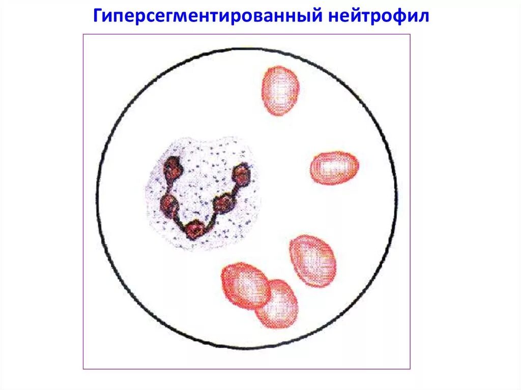 Гиперсегментация ядер нейтрофилов. Гиперсегментированные нейтрофилы. пельгеровская аномалия. пельгеровская аномалия нейтрофилов.
