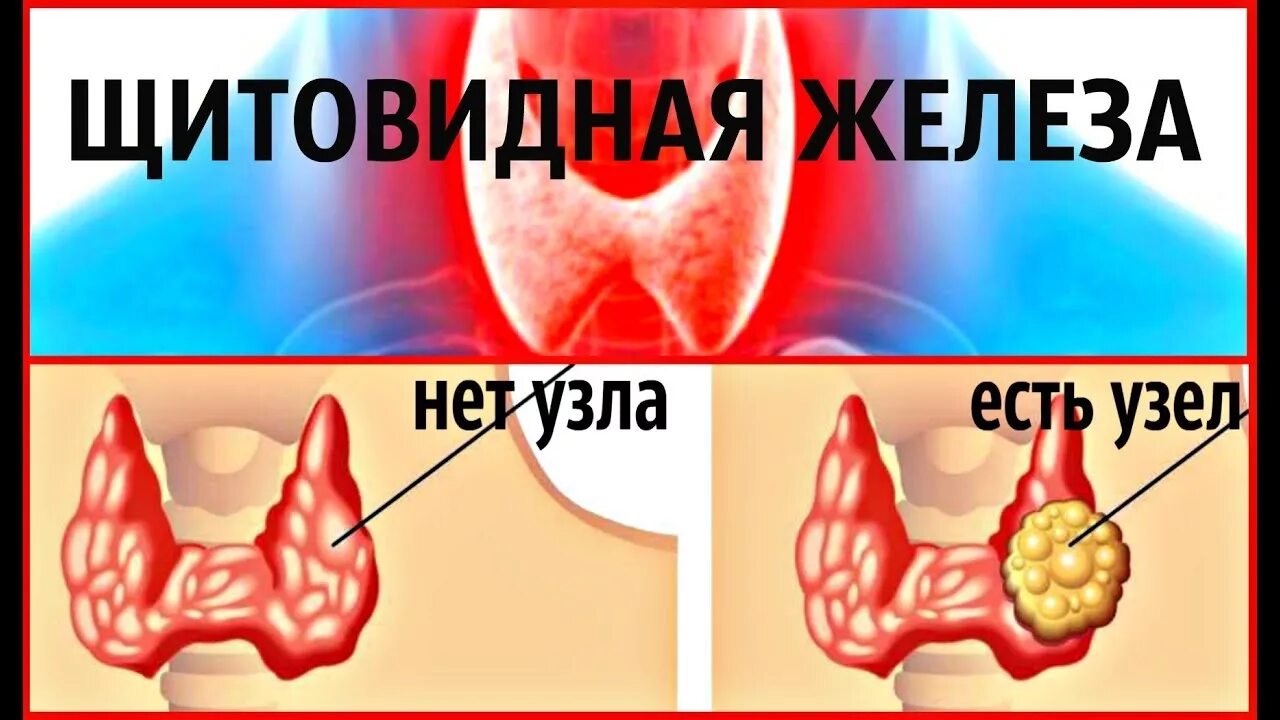 Исцеление щитовидной железы. Нетоксический многоузловой зоб. Узлы в щитовидной железе.