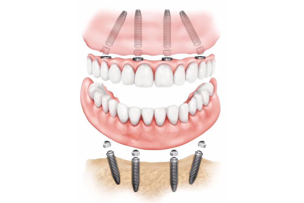 All on 6 цена. Технология имплантации зубов all-on-4.