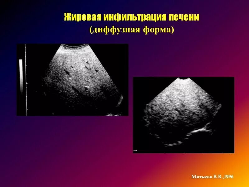 Диффузно жировые изменения печени. Жировая инфильтрация печени на узи. жировой гепатоз печени на узи. очаговая жировая инфильтрация печени на узи. очаг жировой инфильтрации печени.