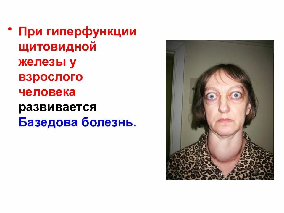 Гиперфункции желез. Базедова базедова болезнь. базедова болезнь развивается при гиперфункции щитовидной железы.. гиперфункция щитовидной железы зоб. эффекты при гиперфункции щитовидной железы.