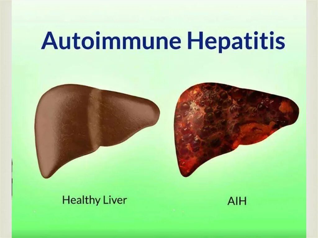 Аутоиммунная печени. Хронический гепатит печень. Здоровая печень и гепатит. Печень пораженная гепатитом.