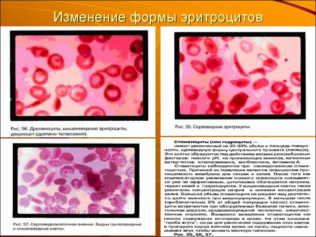 Эритроциты неизменные. Изменение формы эритроцитов. измененные эритроциты. мишеневидные эритроциты. мишеневидные эритроциты анемия.