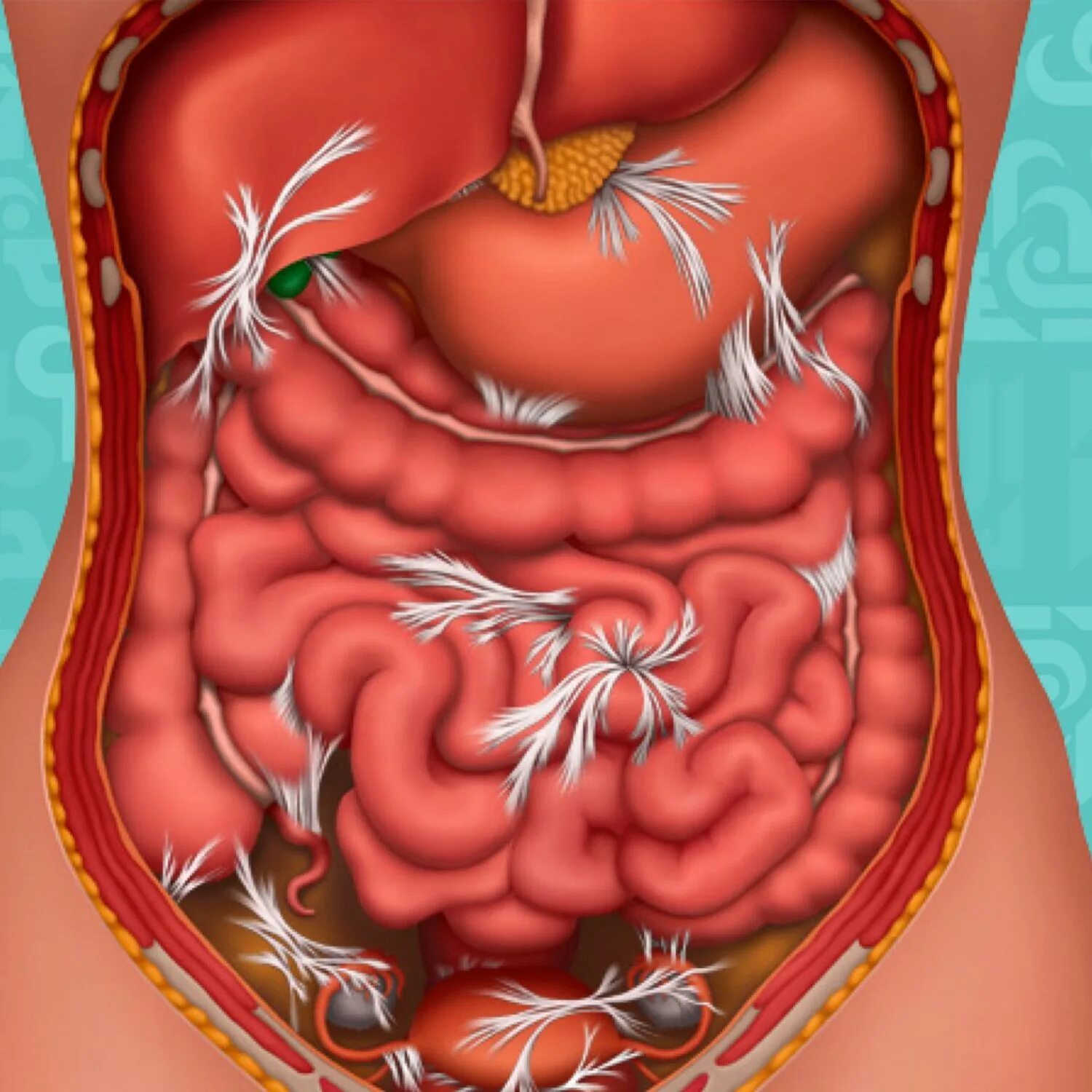 Эндометриоз тазовой брюшины лапароскопия. Спайка тонкого кишечника. Гипертрофический липоматоз. Синехии синдром ашермана. Послеоперационные спайки в брюшной полости.
