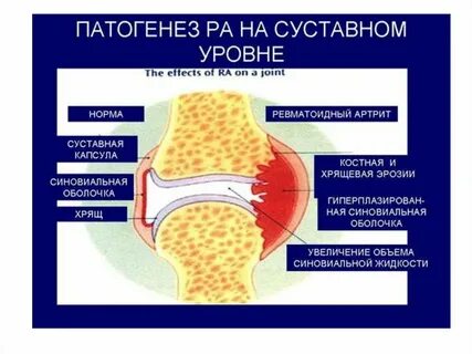 Остеоартроз клинические рекомендации