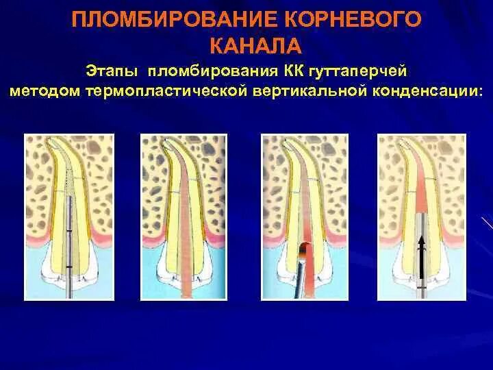 1 корневой канал. Пломбирование методом вертикальной конденсации гуттаперчи. Вертикальная конденсация гуттаперчи этапы. Гуттаперча методы вертикальной конденсации в стоматологии. Штифты для корневых каналов классификация.