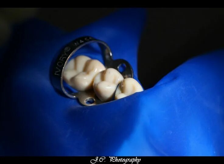 Изолирующая завеса раббердам. Изоляция системой коффердам раббердам. Коффердам (раббердам) стоматологический. Изоляция зуба коффердамом. Коффердам оптидам в стоматологии что это.