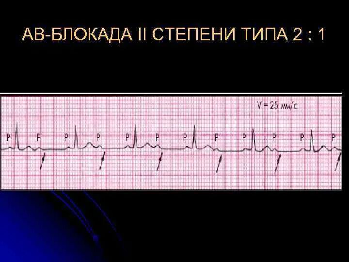 Атриовентрикулярная блокада 2. АВ блокада 2 степени Мобитц 3. Функциональная АВ блокада 2 степени. АВ блокада 2 Мобитц 2. ЭКГ при АВ блокаде 2 степени Мобитц 1.