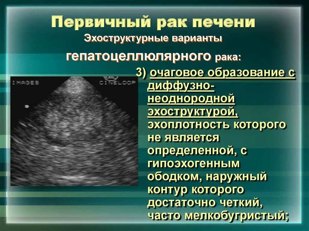 Образование неоднородной структуры в печени. Первичные злокачественные опухоли печени. очаговое образование печени. онкология печени признаки. объемные образования печени на узи.