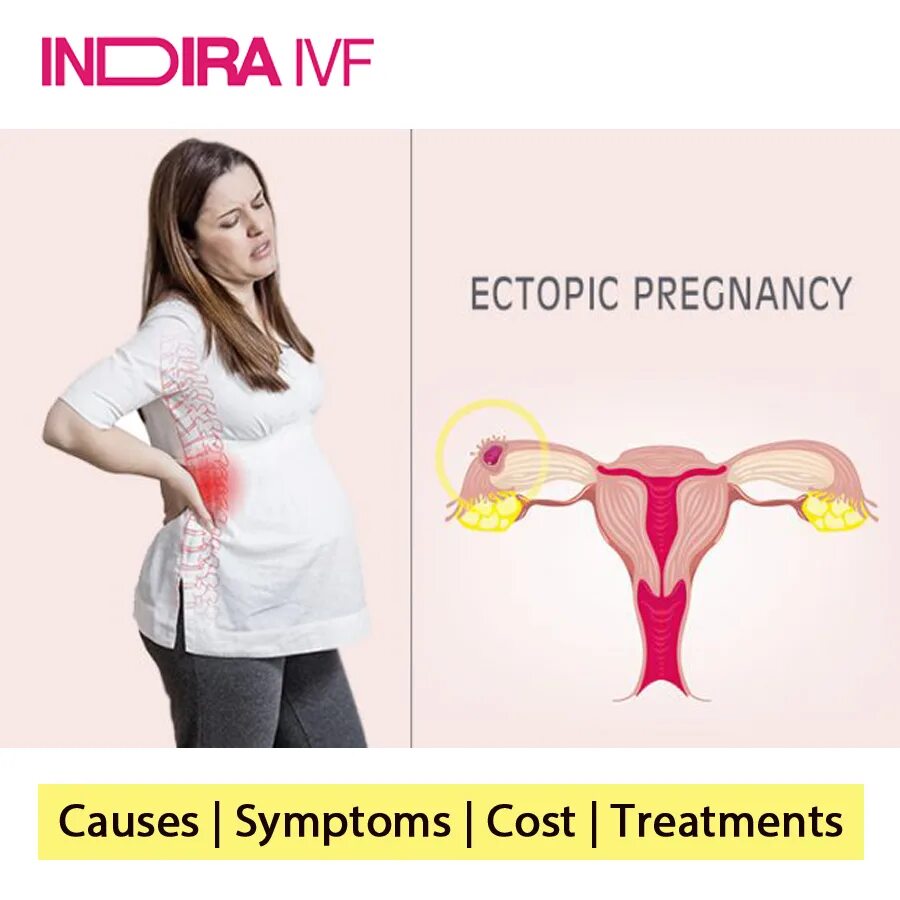 Включи где она беременна. Внематочная беременность. Внематочная беременность фото. Внематочная беременность рисунок. Внеутробная беременность.