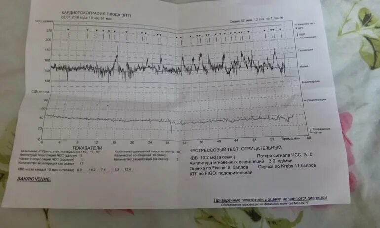 Беременность 34 2 недели. Норма КТГ В 34 недели. Расшифровка КТГ плода 34 недели беременности. Нормальное КТГ плода на 34 неделе беременности. КТГ плода норма 34 недели беременности.
