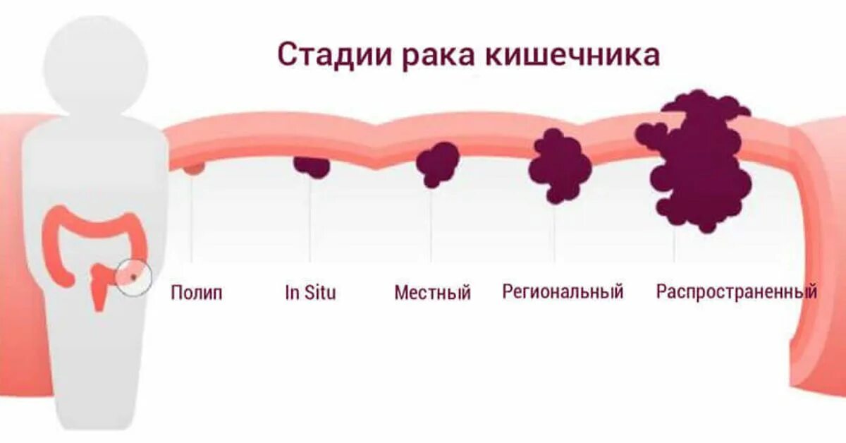 Первая стадия рака кишечника