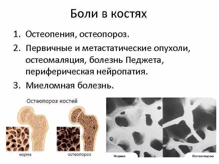 Остеопении