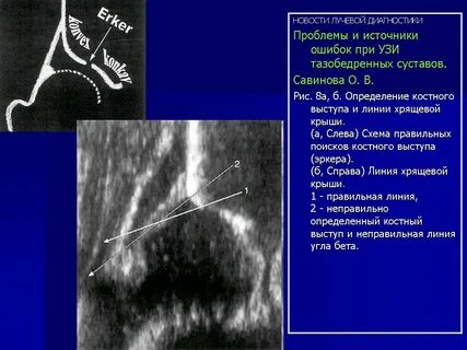 Узи тазобедренного сустава у взрослых