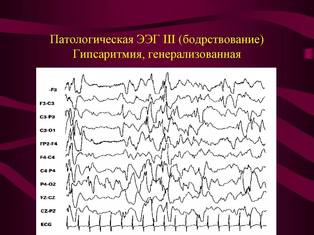 Ээг бодрствования. Гипсаритмия на ЭЭГ. Эпилептические паттерны на ЭЭГ. Гипсаритмия паттерны на ЭЭГ. Эпилепсия на ЭЭГ.